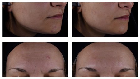 Transformative Ergebnisse: Vorher-Nachher-Fotos mit Sébium Serum