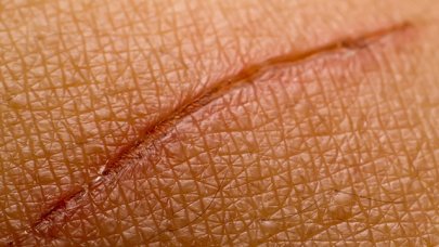 Damaged skin - Scars