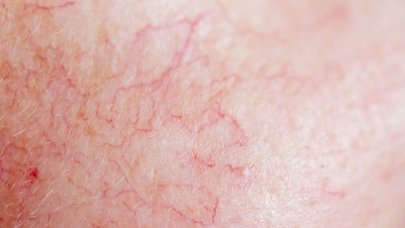 Skin with Redness and Visible Vessels